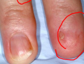 <p>the absence of nails on fingers or toes. </p>