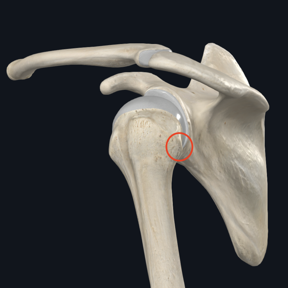 <p>Quel muscle se fixe sur la partie moyenne du <strong><em>tuberculus majus humeri</em></strong> (face <strong><em>inférieure</em></strong> du grand tubercule de l’humérus) ?</p>