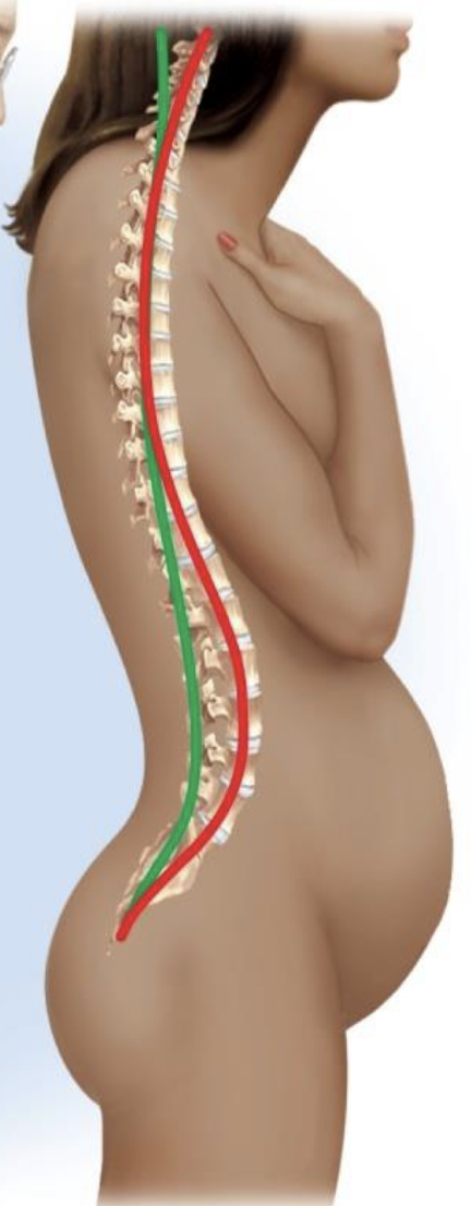 <p>what abnormal curvature is depicted</p>