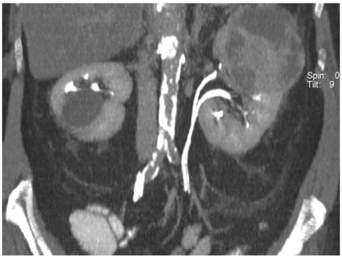 <p>puede ser </p><p>Completa → Los uréteres llegan separados a la vejiga.</p><p>Incompleta → Se fusionan antes del meato vesical.</p>