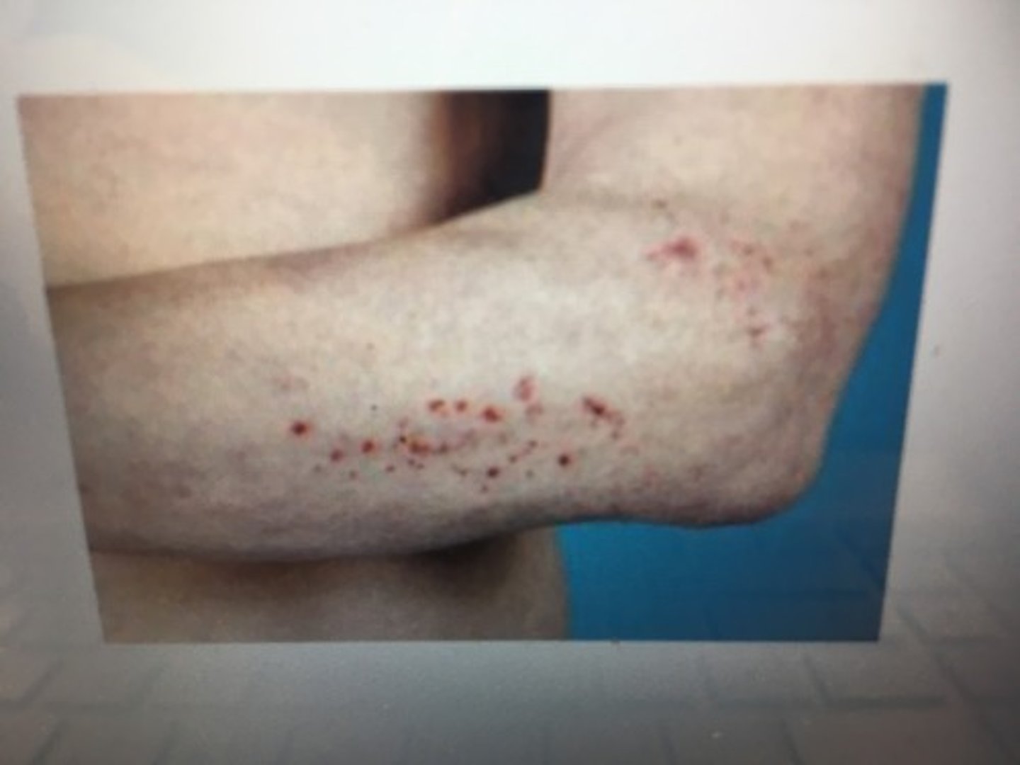 <p>= een epidermodermaal defect dat iets dieper gelegen is dan een erosie (hierbij zijn puntvormige bloedingen zichtbaar)</p>