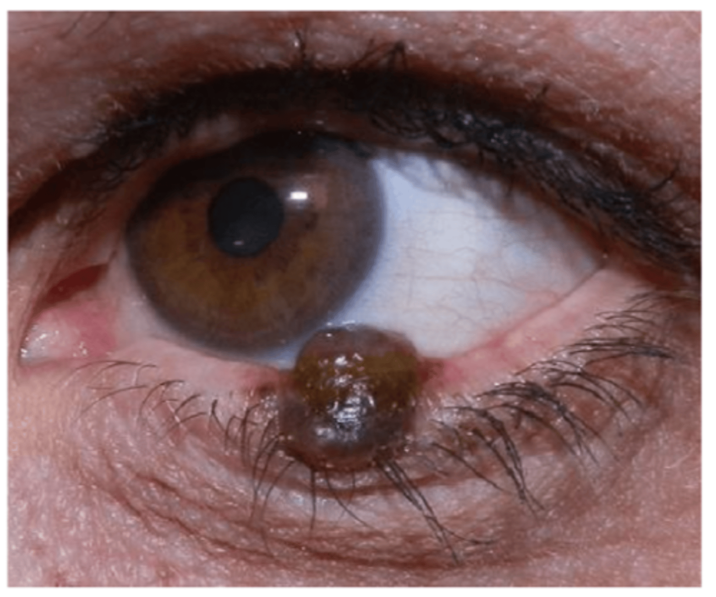 <p>fair skin</p><p>increased UV exposure</p><p>older age</p><p>no gender preference</p>