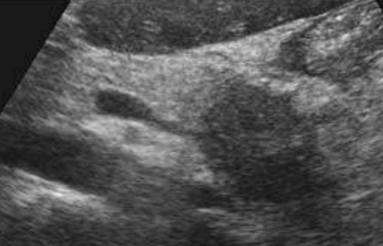 <p>Autosomal dominant disorder (genetic)</p><p>Causes tumors and cysts to grow</p><p>Affects the CNS and other organs (65-75% of pt’s have pancreas involvement)</p><p>Sono: rim-like peripheral calcifications. Carcinoma is solid and irregular plus liver mets</p><p></p>
