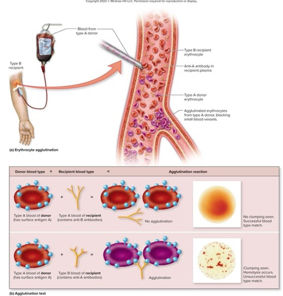 <p>Clumping of erythrocytes due to incompatible transfusion.</p>