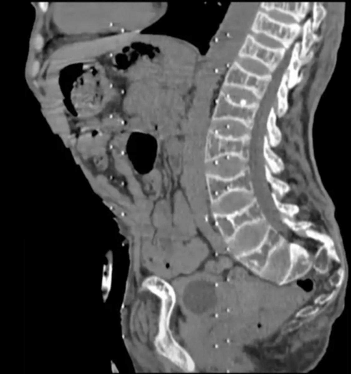 <p>What is this?</p><p>Ex. Pt has hyperparathyroidsm</p>