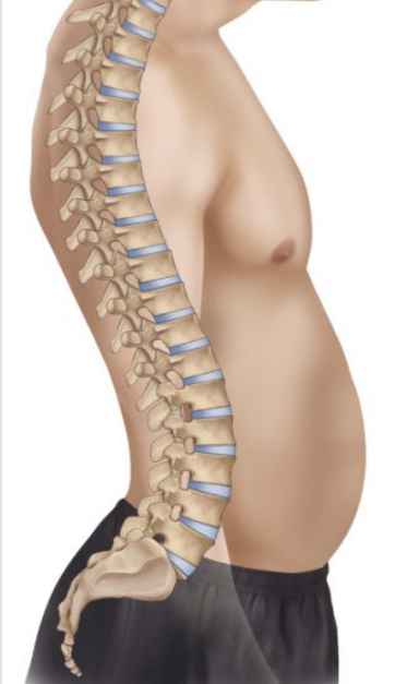 <p>hyperkyphosis</p>