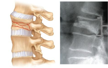 <p>Bone is crushed. Common in porous bones (i.e., osteoporotic bones) subjected to extreme trauma, as in a fall.&nbsp;</p>