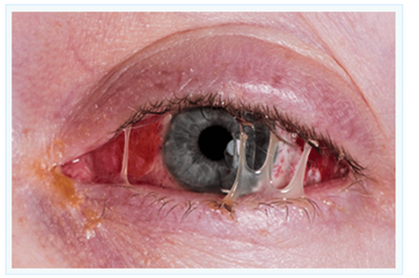 <p>-pink or red color in the sclera of the eyes</p><p>-swelling</p><p>-excessive tears</p><p>-yellow-green, purulent discharge (bacterial)</p><p>-crusting of the eyelids in the morning (bacterial)</p><p>-watery eye discharge (viral)</p>