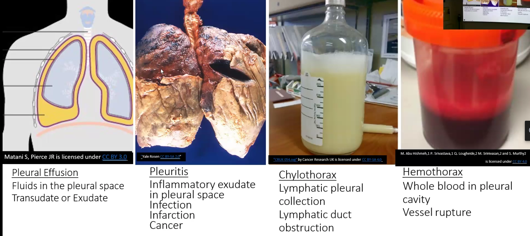 <ul><li><p>Transudate: thin, watery with few cells/proteins, causes hydrothorax, most commonly caused by congestive heart failure</p></li><li><p>Exudate: protein content is high and contains inflammatory cells, suggests pleuritis (inflammation of pleura)</p></li></ul><p></p>