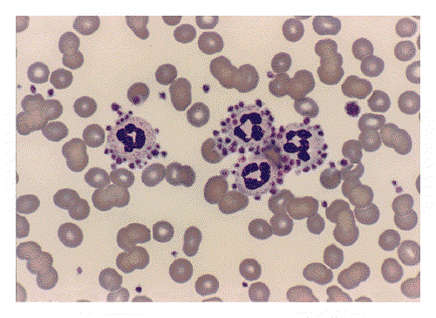<p>Pseudothrombocytopenia</p>