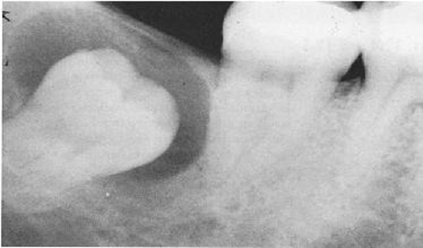 <p>-Odontogenic cyst</p><p>-Follicular cyst</p><p>-Cyst around the CROWN of an IMPACTED TOOTH</p><p>-MANDIBULAR 3RD MOLARS most common site</p><p>-UNILOCULAR, PERICORONAL RADIOLUCENCY</p>