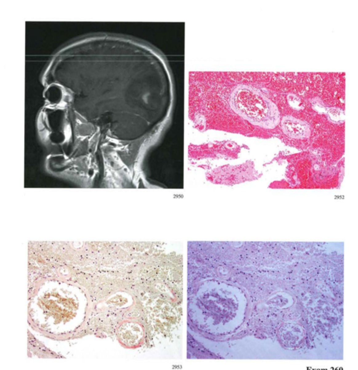 <p>Define Cerebral amyloid angiopathy</p>