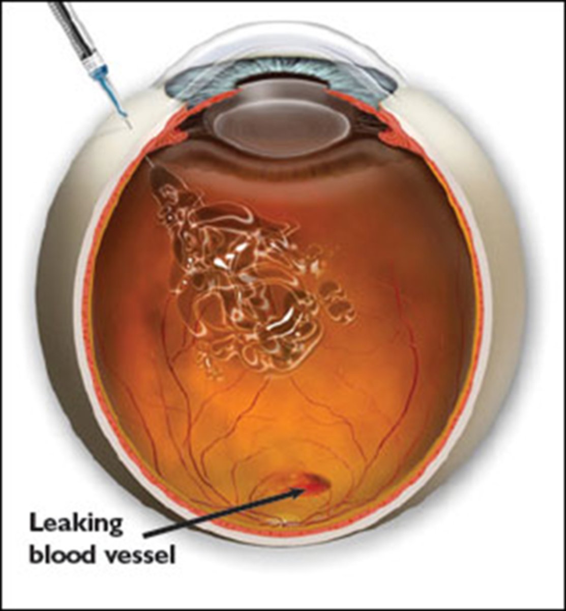 <p>What is the preparation for intravitreal injections?</p>