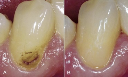 <p>what class lesion is this&nbsp;</p>