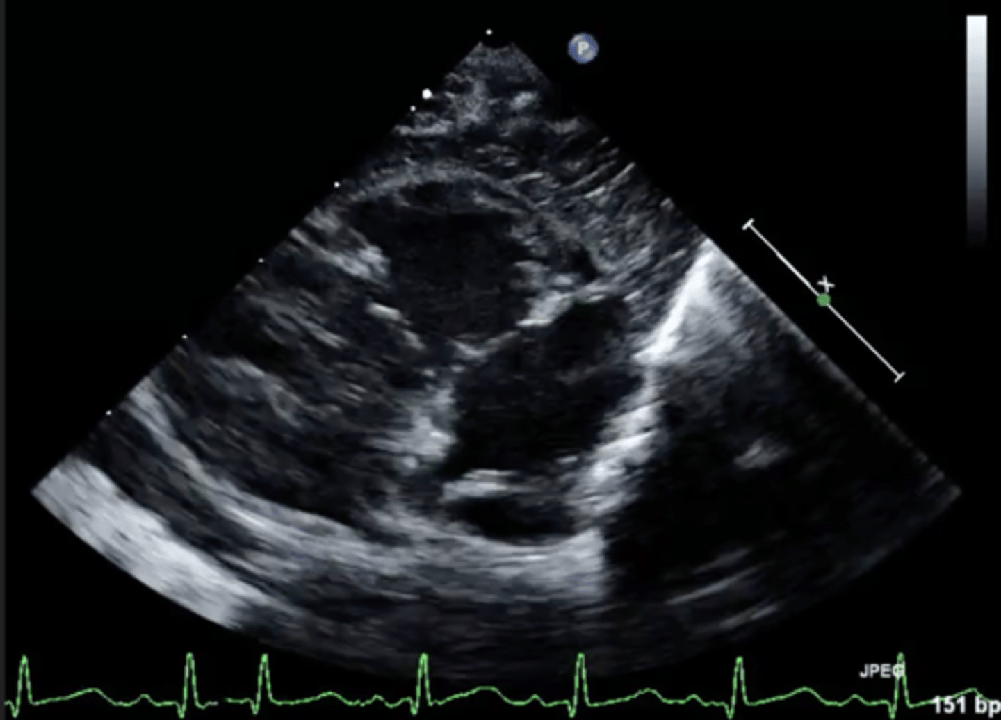 <p>posterior tricuspid valve leaflet</p>