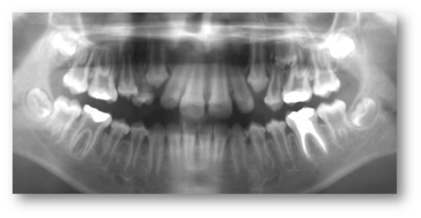 <p>Patient presents with the following radiographic features:</p><p>-Premature closure of skull sutures</p><p>- Gyral/ convolutional markings on skull resembling ‘beaten metal’</p><p>- generalized decrease bone density</p><p>- Thin enamel</p><p>- large pulp chamber and root canal</p><p>- thinning of lamina dura</p><p>Patient has a history of premature loss of primary teeth and delayed eruption of secondary teeth. What is the diagnosis?</p>