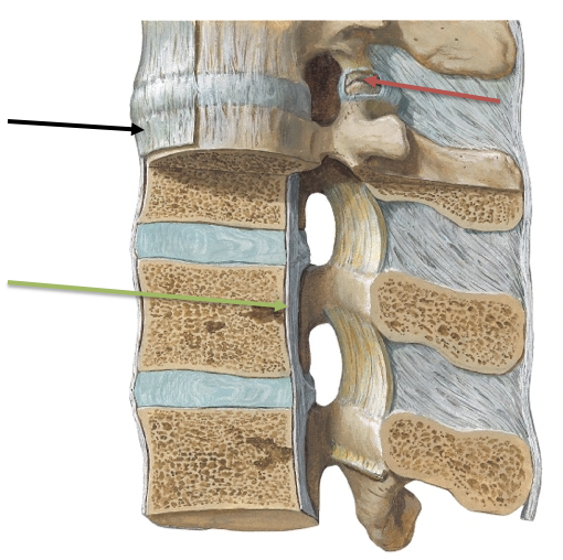 What is the red arrow pointing at?

\
A. Anterior longitudinal ligament

B. Facet Joint and Capsule

C. Posterior longitudinal ligament