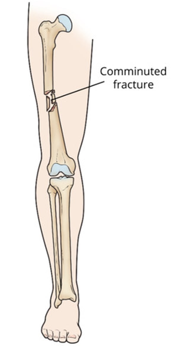 <p>Comminuted Fracture</p>