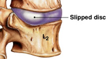 <p>Which type of damage to the intervertebral discs has:</p><ul><li><p>Bulge in annular fibers</p></li><li><p>Can invade vertebral canal or IVF</p></li><li><p>Protrusion</p></li></ul><p></p>