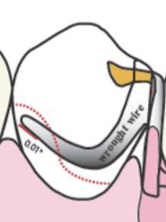 <p>describe reciprocal clasp assembly of combination clasps</p>