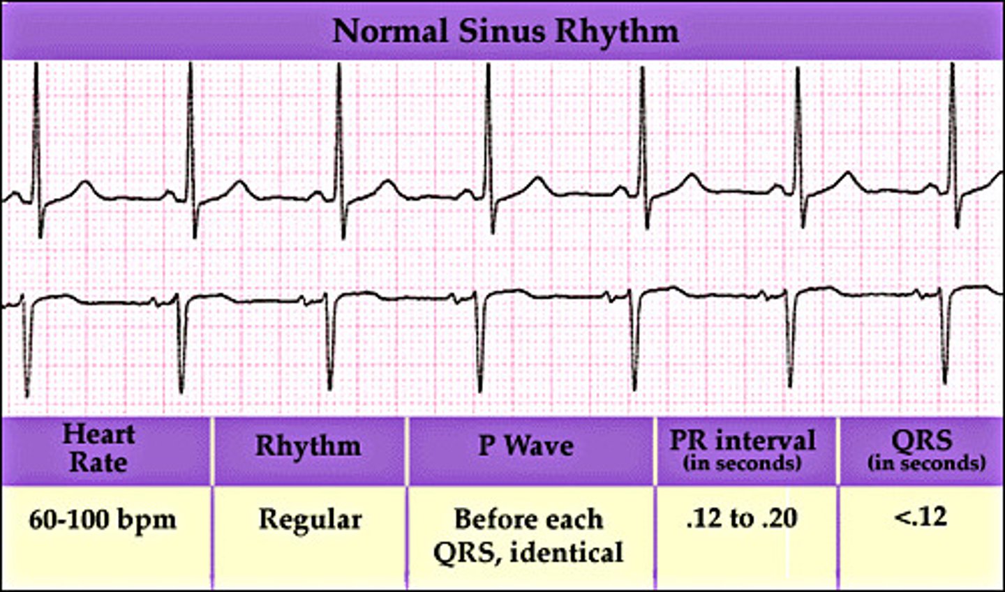 <p>Sinus rhythm</p>