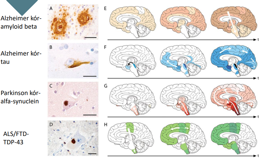 <p>Alzheimer: amyloid beta, tau</p><p>Parkinson kór: alfa-synuclein</p><p>ALS/FTD: TDP-43</p>