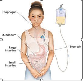 <p>Enteral Feeding (EN)</p>