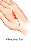 <p>Slow And Oozing </p><p>Easily Controlled </p><p>Stops Spontaneously</p>