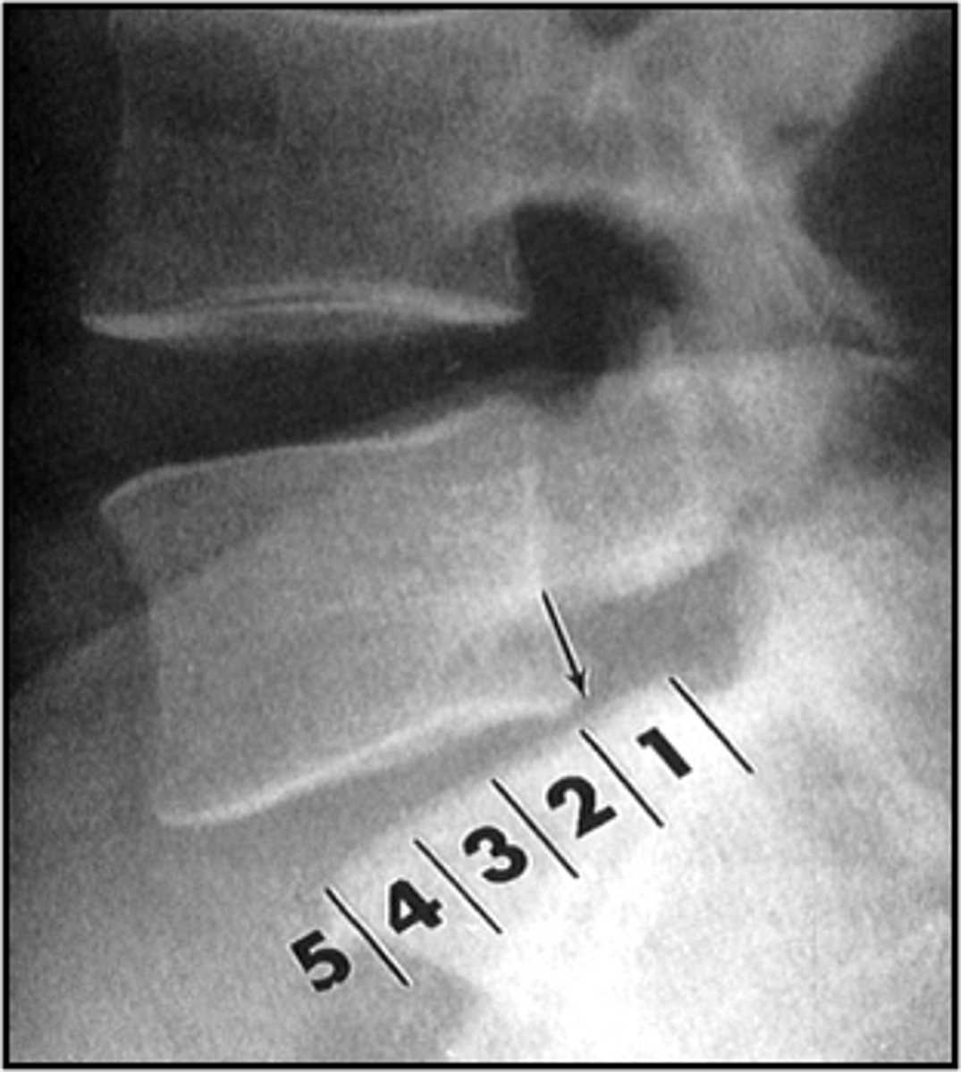 <p>ID spondylolisthesis measurement</p>
