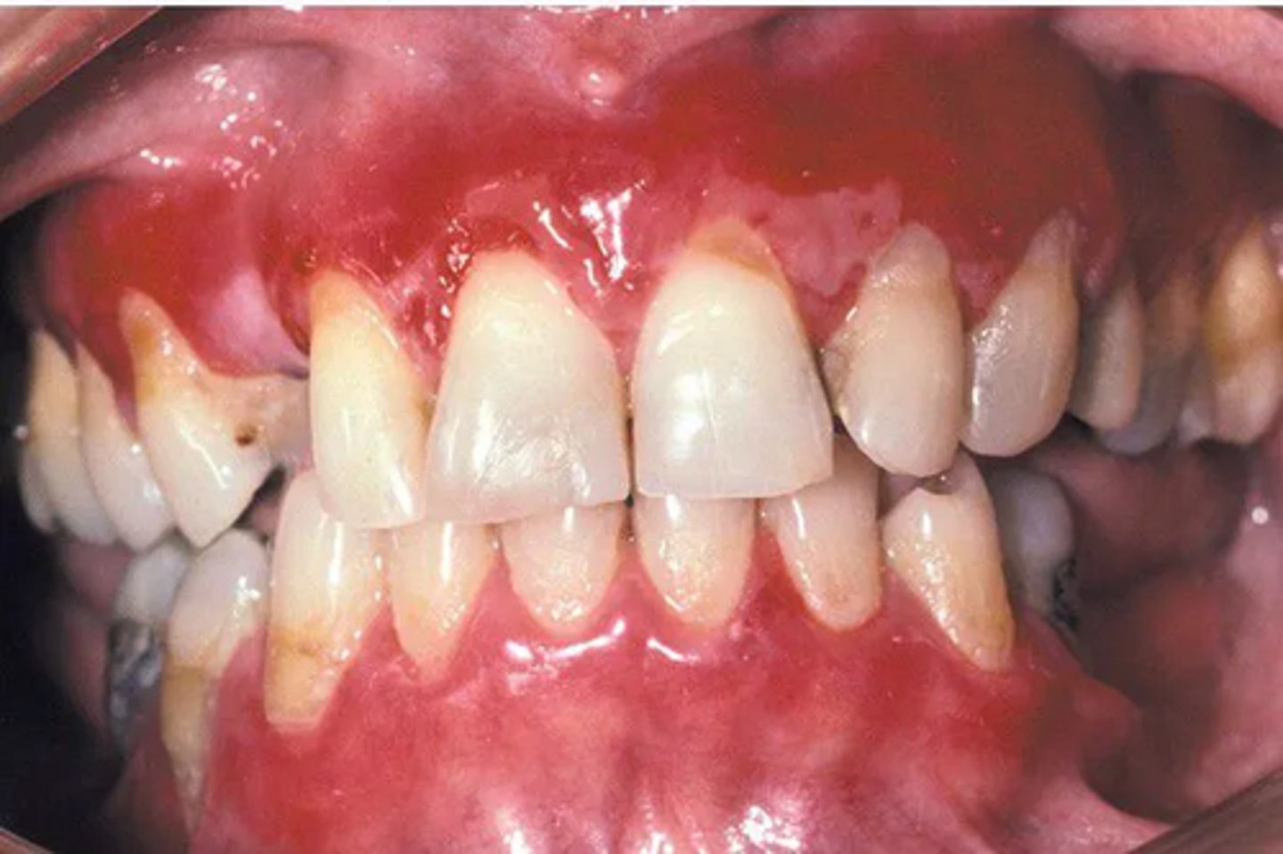 <p>A patient presents with desquamative gingivitis and intact bullae. Which is the MOST likely diagnosis?</p>