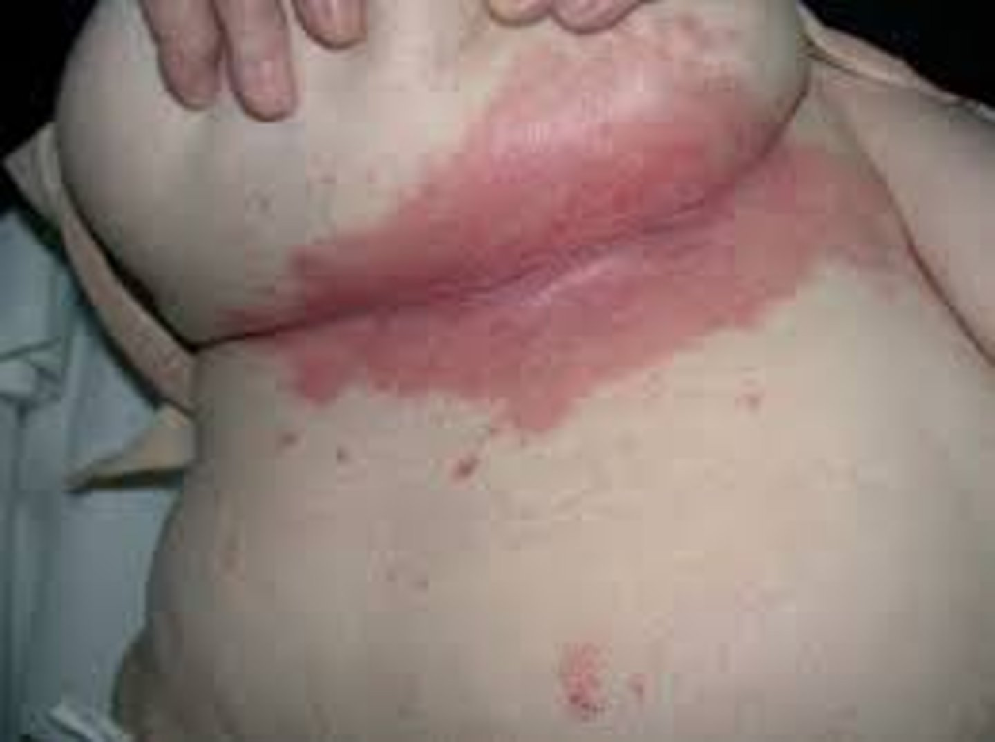 <p>Intertrigo (Candidiasis)</p>