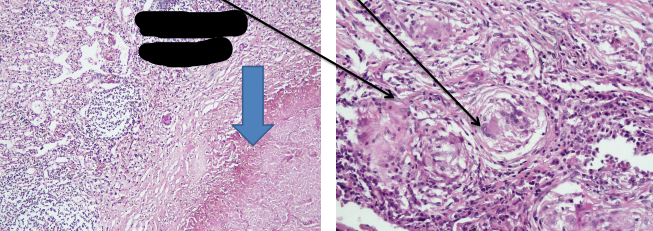 <p>identify ? </p><p>composed of ?  اكبر من انه يجي فكك</p><p>giant cells here are named ? </p>