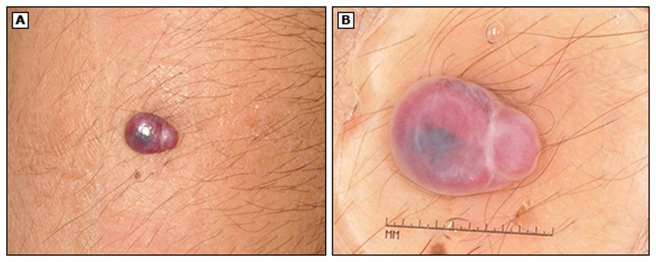 <p>what lesion has this appearance under a dermatoscope?</p><p><strong>pink, homogenous papule w/ white septa</strong></p>