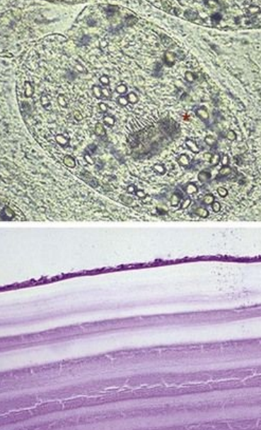 <p>8.4 Side B (PBD9: 396; BP9: 313)<br></p>
<p><br></p>
<p>Questions<br></p>
<p>A 43-year-old man skins a fox, cuts himself, develops pain and seizures years later; cystic lesion in the aqueduct of Sylvius is excised.<br></p>
<p><br></p>
<p>1. What parasitic infection does he likely have, and what is shown in the upper panel?<br></p>
<p>2. What tissue sites are most often involved?<br></p>
<p>3. Name the presenting signs and symptoms.<br></p>