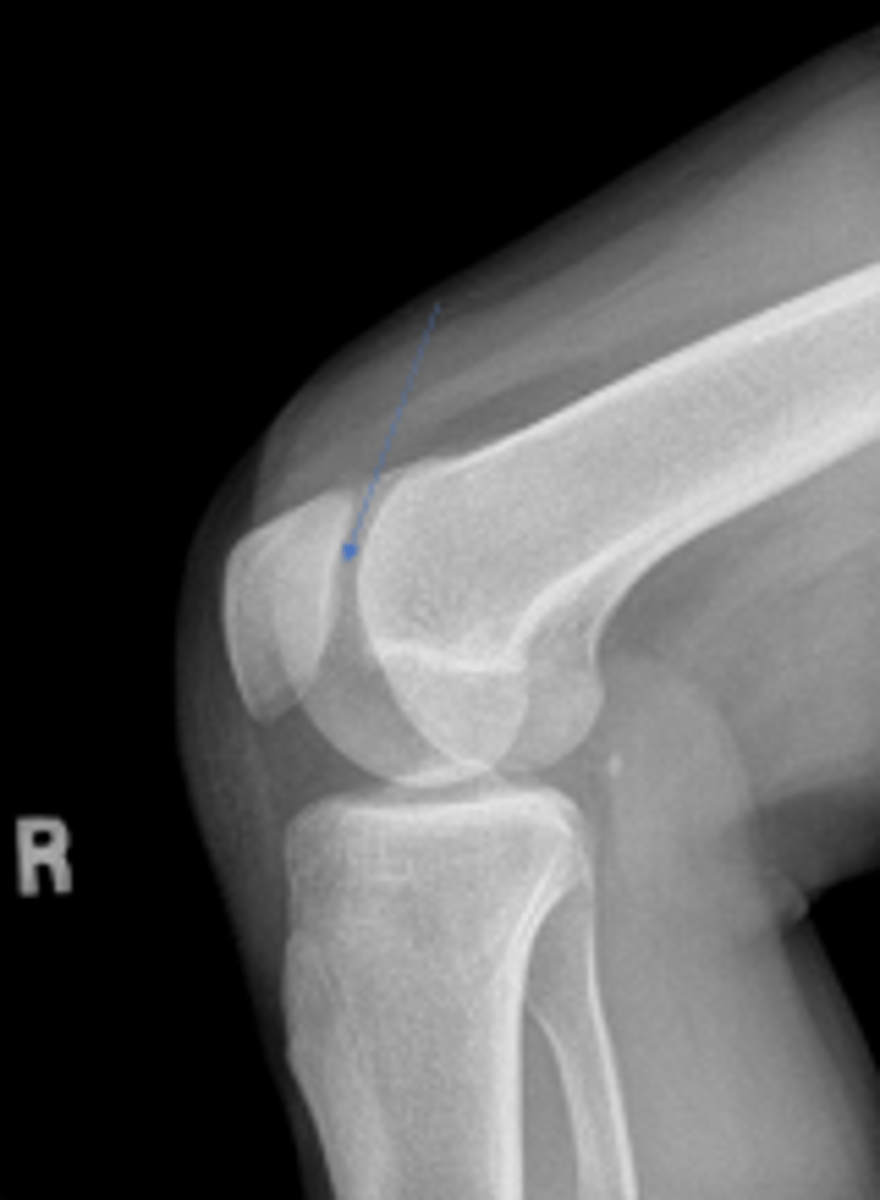 <p>What joint space is the arrowing pointing to?</p>