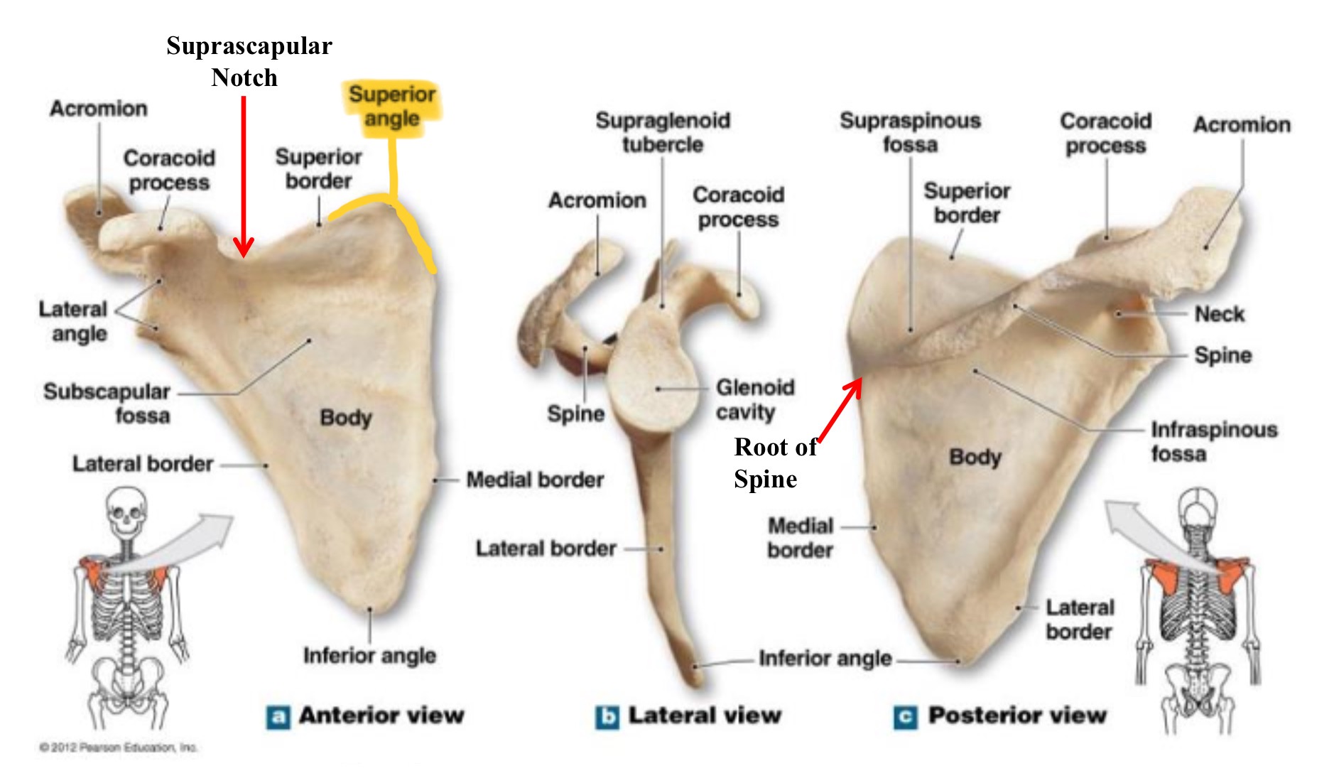 <p>superior angle of scapula</p>
