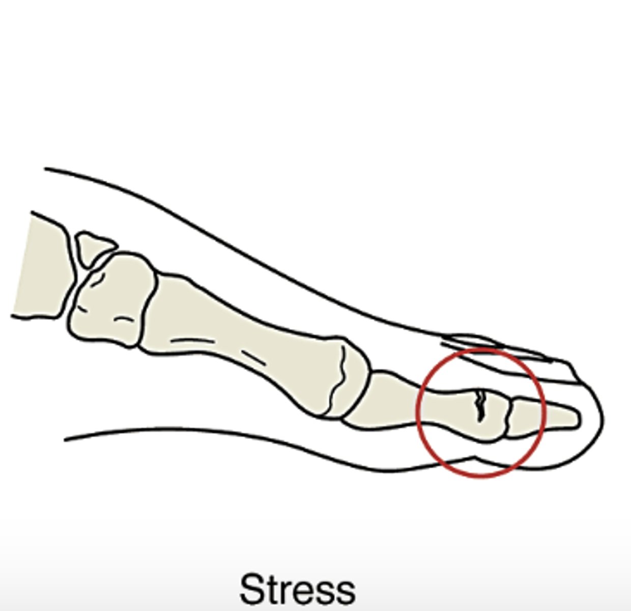 <p>results in the bone being fractured across one cortex. this is an incomplete fracture.</p>