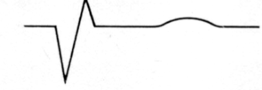Pathological Q waves & loss of R waves.
