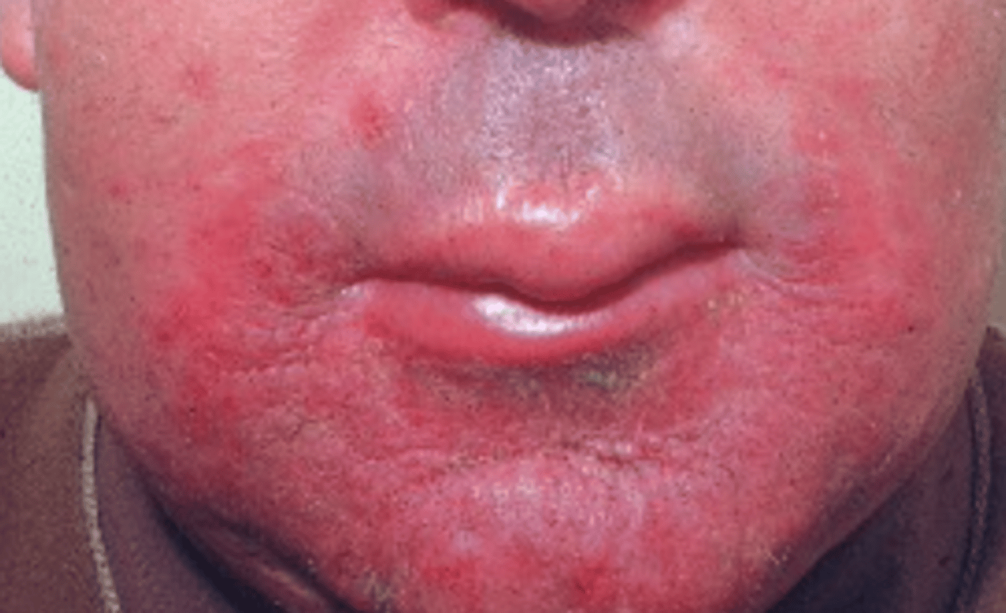 <p>Which organism likely caused this condition?</p>