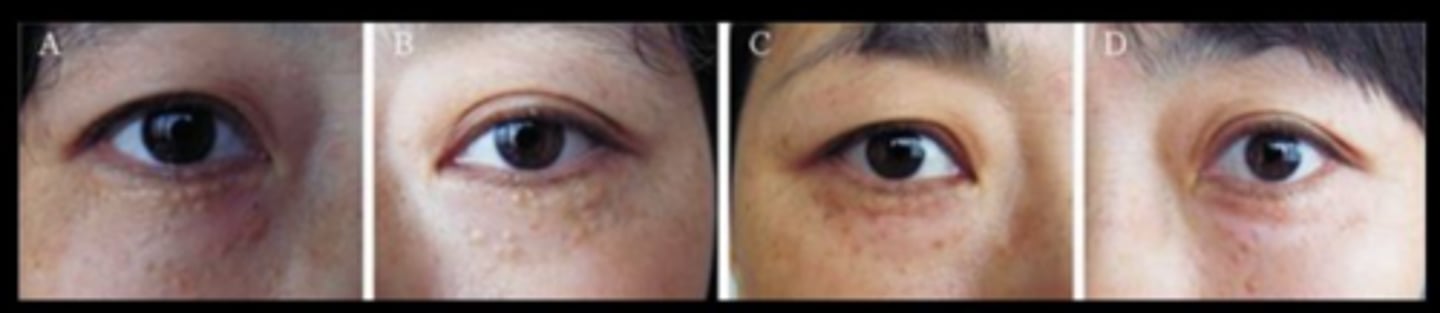 <p>shave excision = high risk of scar</p><p>chemical peel = bichloracetic acid or tretinoin</p><p>electrocautery/RF</p><p>CO2 or Er:YAG laser = least scar potential</p>