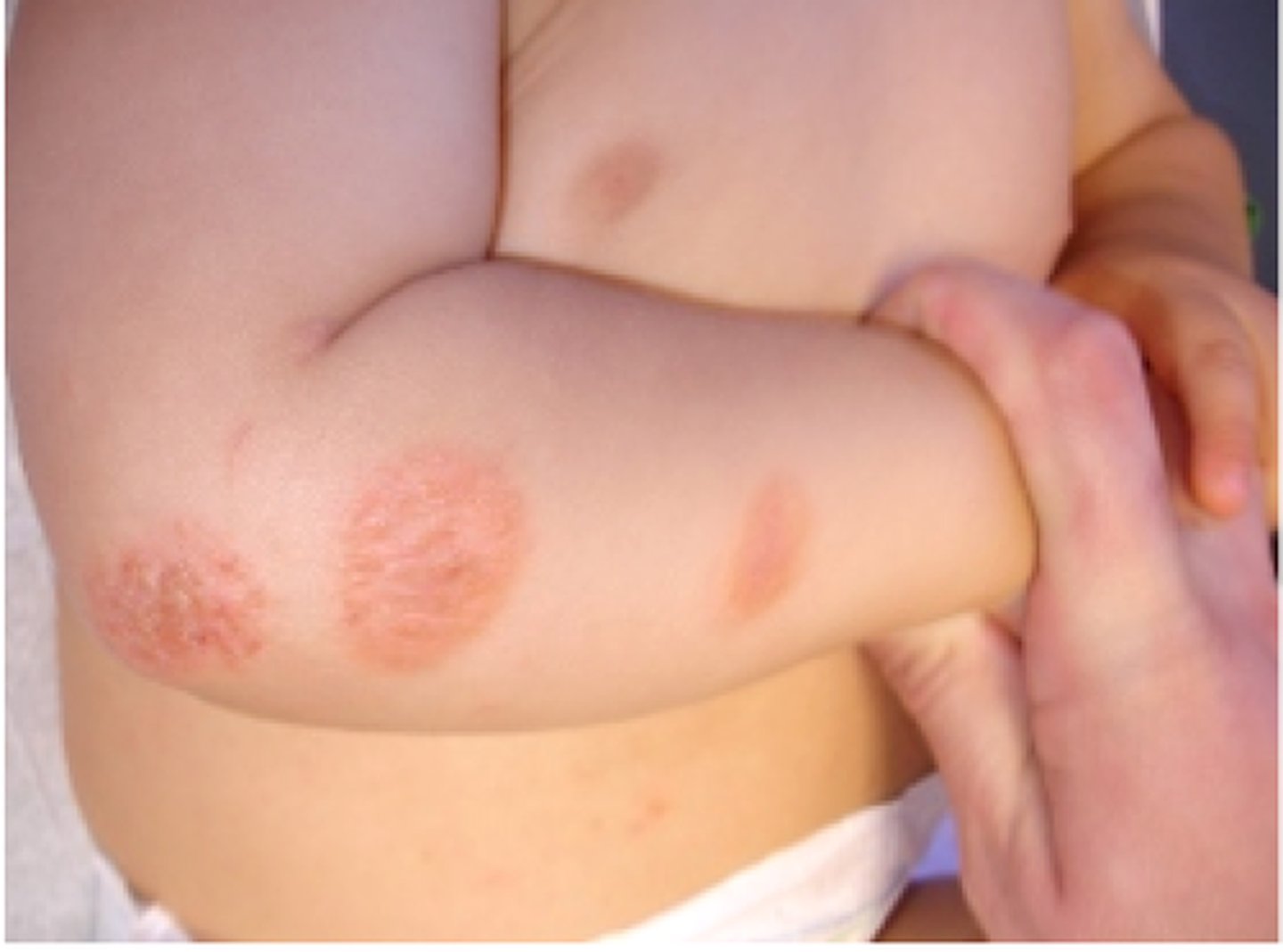 <p>diagnose this image:</p><p>Nummular, scaly, erythematous papules and plaques</p>
