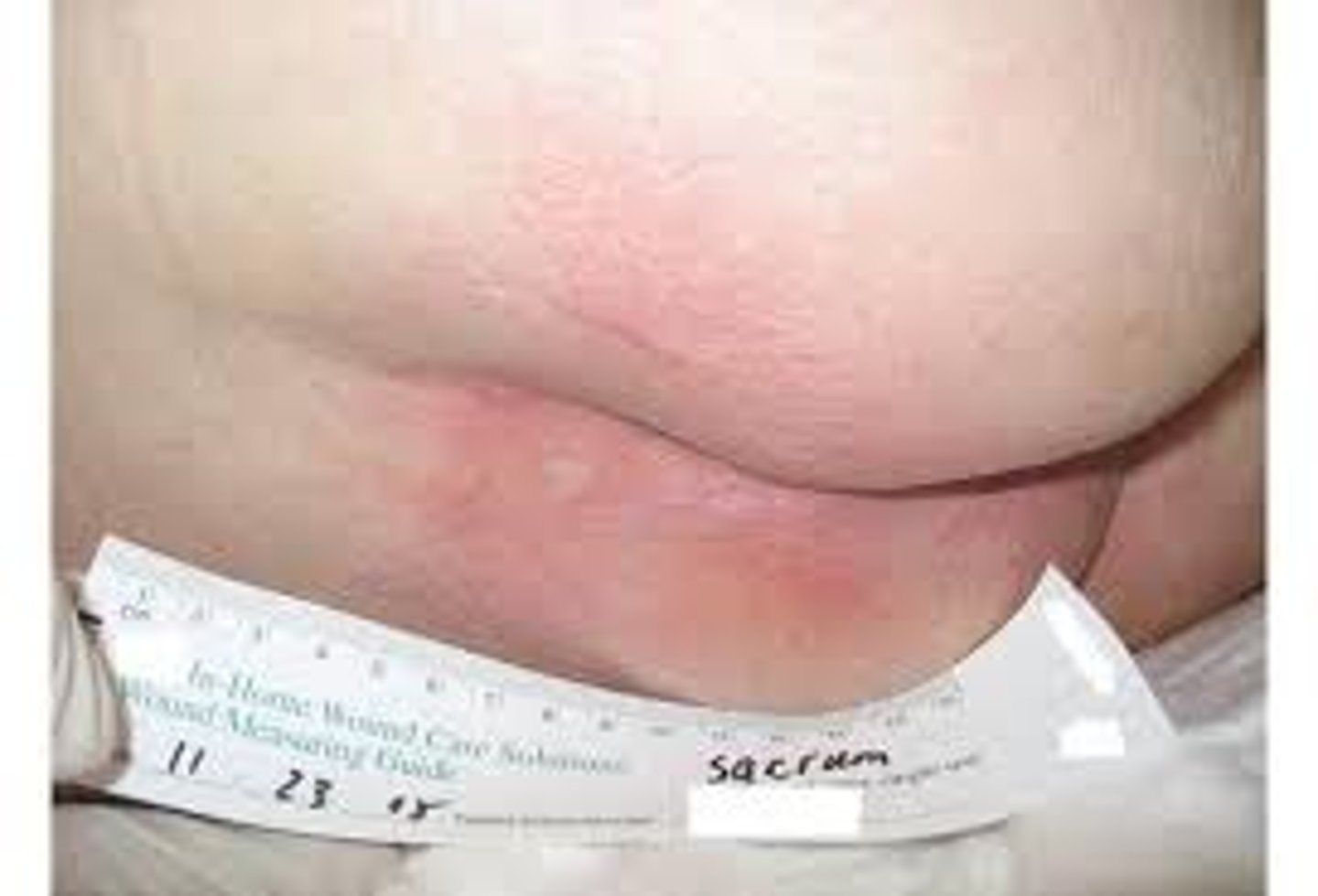 <p>Intact skin with localized area of nonblanchable erythema</p>