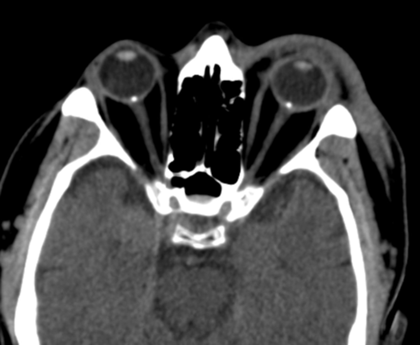 <p>hyper-reflective if calcified</p>