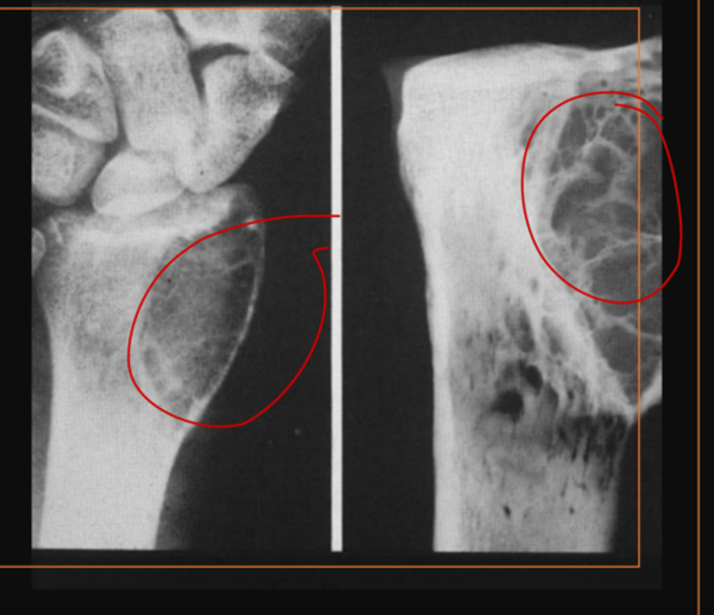 <p>what is this and what disease process</p>