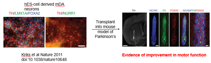 <p>Cell replacement therapy aims to treat diseases caused by the death or dysfunction of a specific cell type by replacing them with healthy, functional cells grown in the lab. <br><br>Case Study: Parkinson's Disease</p><ul><li><p><strong>Pathology:</strong> Parkinson's is a neurodegenerative disorder caused by the progressive loss of midbrain dopaminergic (mDA) neurons in the substantia nigra. This leads to symptoms like tremor, rigidity, and slowness of movement.</p></li><li><p><strong>Strategy:</strong></p><ol><li><p>Differentiate human pluripotent stem cells (hPSCs) *in vitro* into pure, functional mDA neurons (expressing key markers like Tyrosine Hydroxylase (TH), LMX1A, and FOXA2).</p></li><li><p>Transplant these lab-grown neurons into the brains of patients.</p></li></ol></li><li><p><strong>Progress:</strong> This approach has shown great promise in animal models of Parkinson's, with transplanted neurons surviving, integrating, and leading to significant improvement in motor function. This has progressed to Phase I clinical trials in human patients.</p></li></ul><p></p>