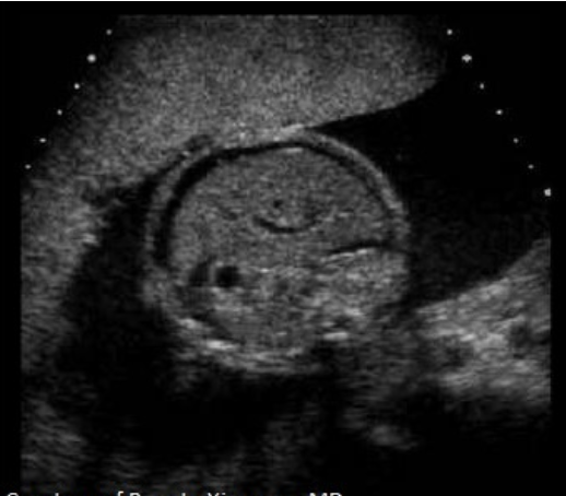 <p>which should be evaluated to clarify the findings</p><p>.</p><p>a) fetal limbs to r/o arthrogryposis</p><p>b) fetal head to r/o anasarca</p><p>c) fetal spine to r/o spina bifida</p><p>d) fetal face to r/o clefting</p>
