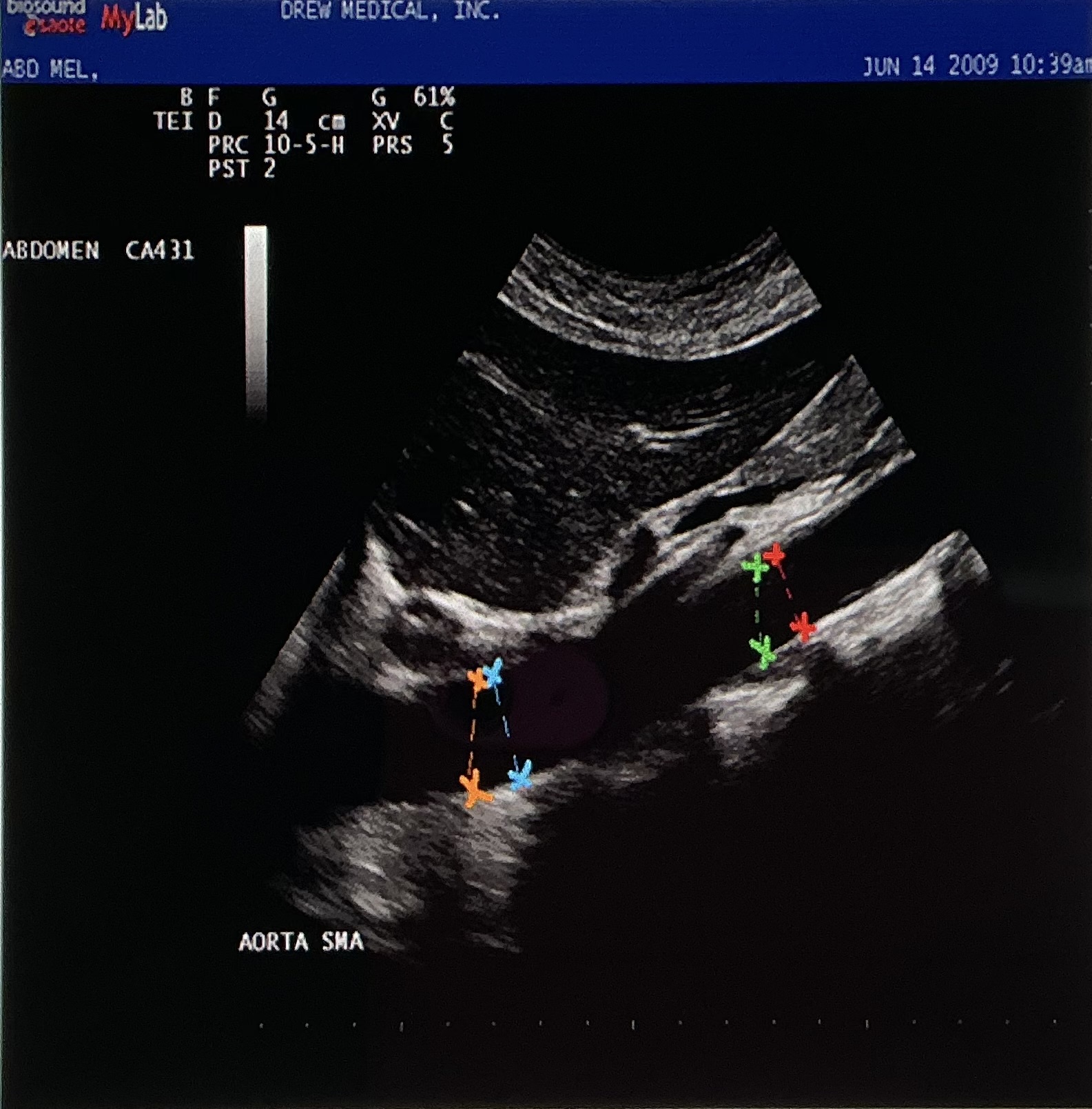 <p>The image is demonstrating the aorta from what probe orientation?</p>