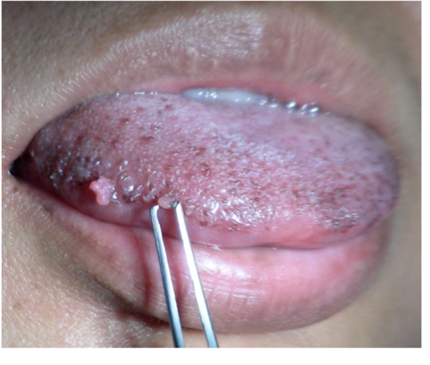 <p>Commonly HPV-6 and -11</p><p>benign HPV lesions are removed surgically or by cryotherapy</p><p>May recur</p>