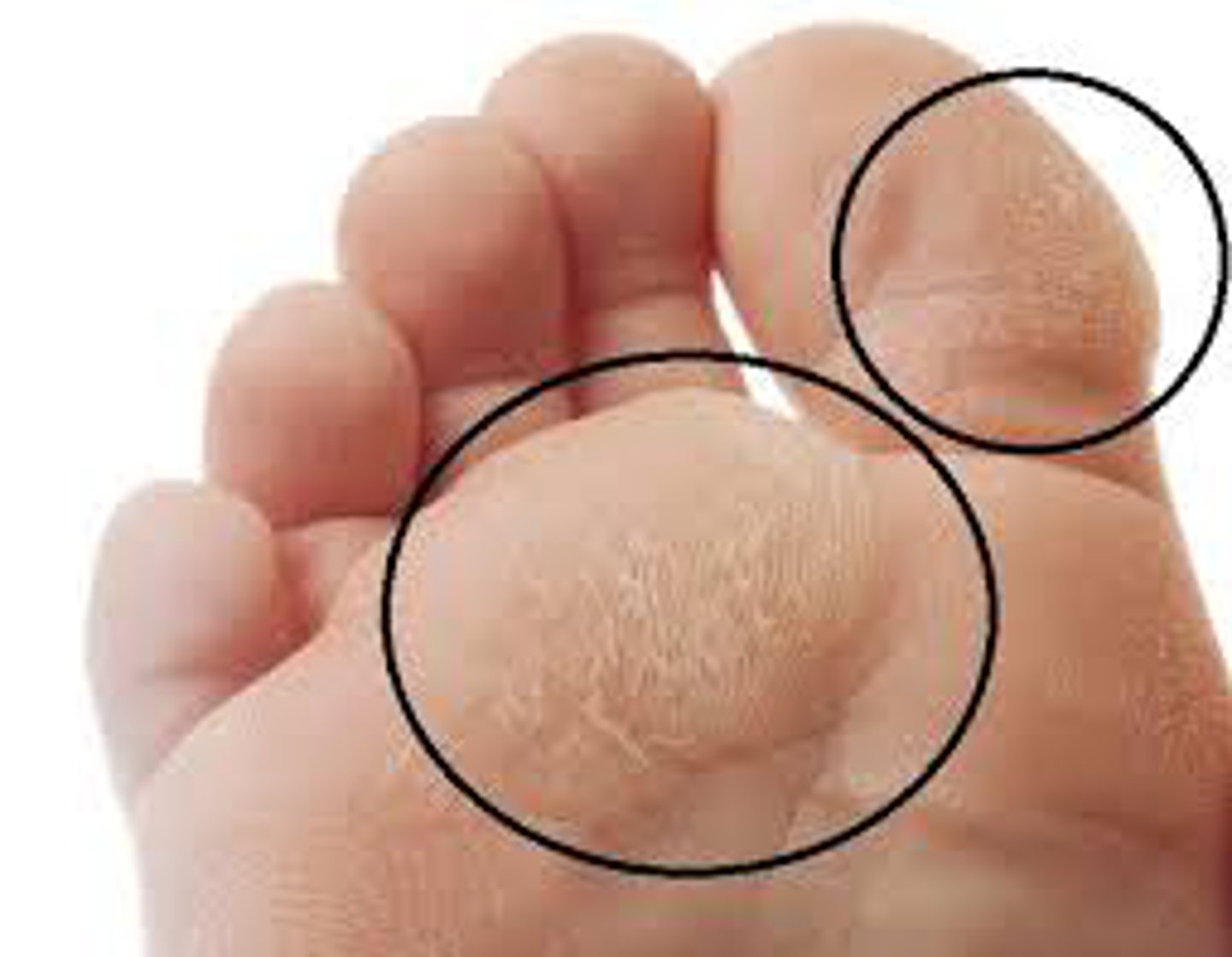 <p>a hardened thickened place on the skin,</p><p>caused by friction and pressure from repeated actions,</p><p>can develop on palms of hands and soles of feet</p>