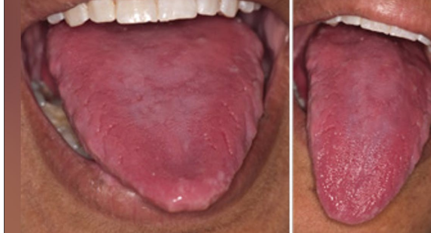 <p>angular cheilitis, atrophic tongue, glossitis, burning sensation maybe due to candidiasis </p>